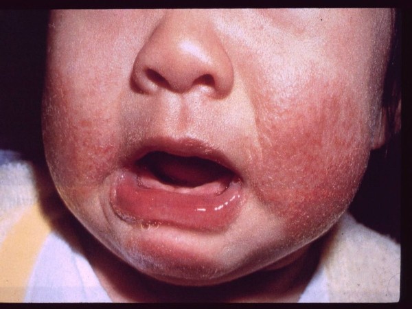 Baby Eczema on Face - Courtesy of National Eczema society