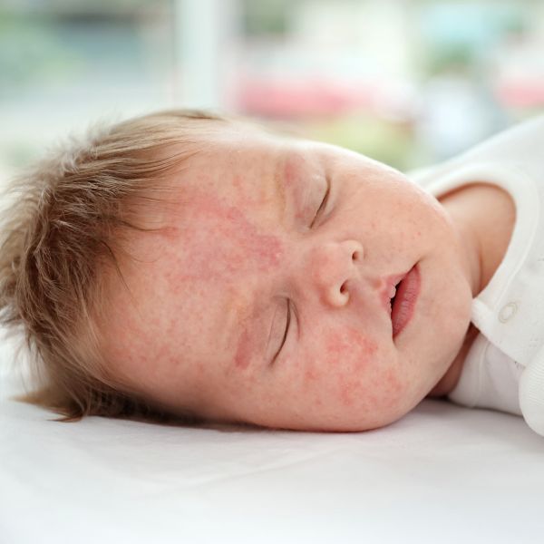 Can Baby Wipes Cause Eczema